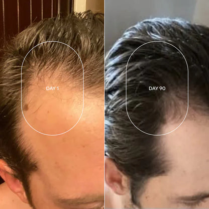 🔥2X1 Roll-On de Romero para el Crecimiento Capilar | Estimula Folículos y Fortalece el Cabello